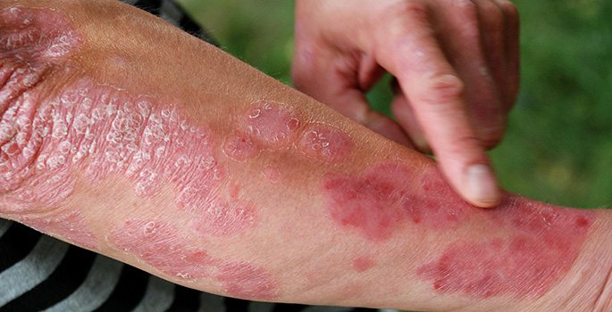 Ny behandling av psoriasis testas