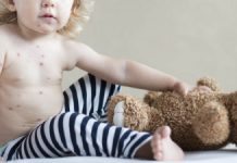 Avråder från ibuprofen vid vattkoppor