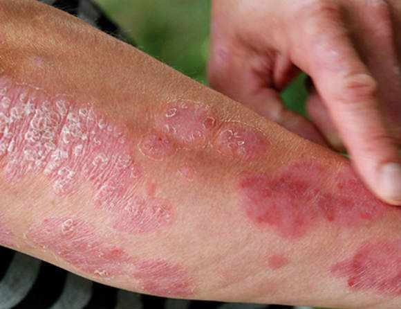 Så ska psoriasis behandlas enligt nya riktlinjer