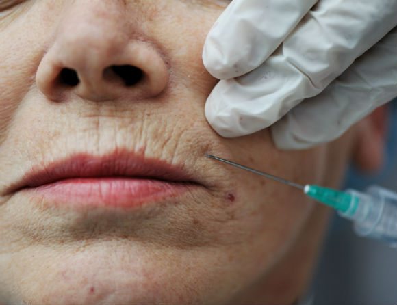 Apoteken ska hjälpa till att stoppa fusk med botox