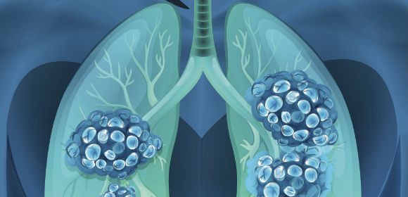 Ökar överlevnaden i svår lungcancer