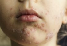 Vattkoppsvaccin kan bli gratis – oklart om bältros Läkemedelsvärlden