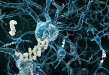 Läkemedel mot Alzheimer godkänt men med villkor Läkemedelsvärlden