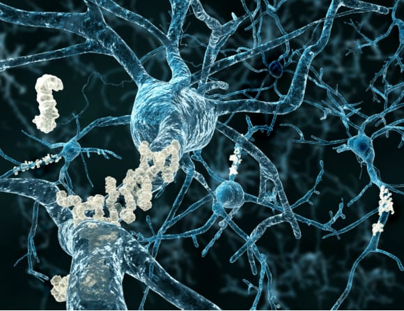 Studie blev bakslag för antikropp mot Alzheimer