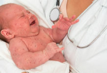 Fler länder inför obligatoriska vaccin Spädbarn med mässling.