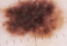 Cellterapi prövas mot malignt melanom