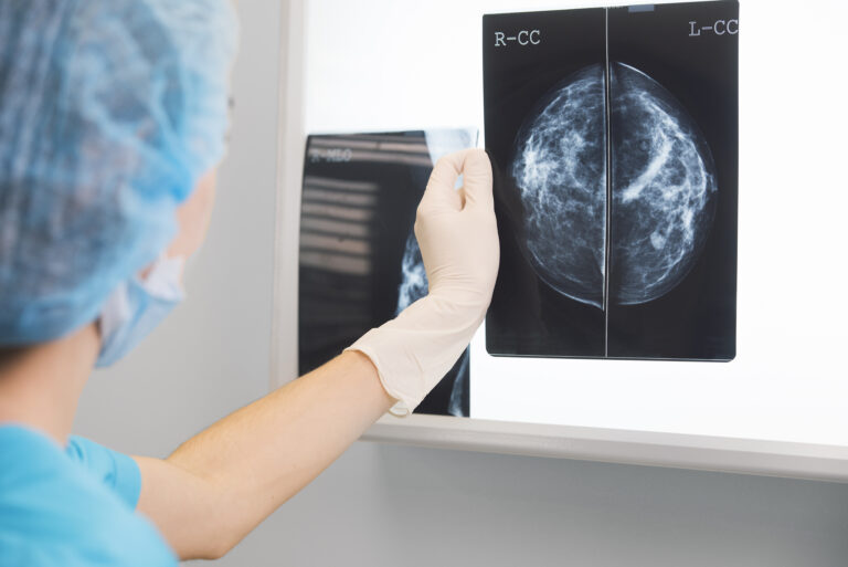 Forskare: AI redo bli klinisk rutin i mammografin