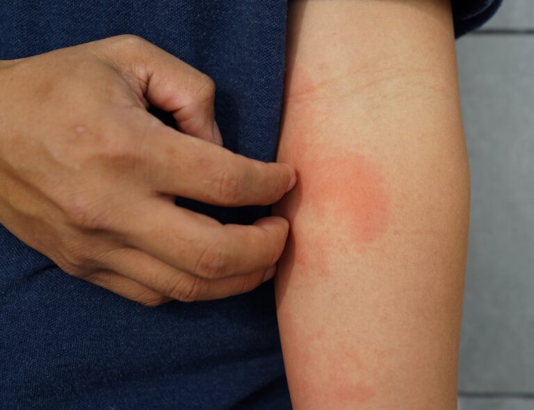 Covid-19-vaccinering var säker trots allergier