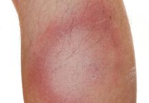 Vaccinkandidat mot borrelia blir försenad Läkemedelsvärlden