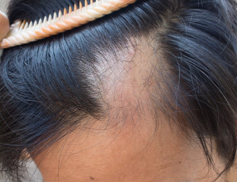 FDA har godkänt JAK-hämmare mot håravfall