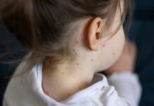 Vaccin till barn mot vattkoppor införs 2027 Flicka med vattkoppor