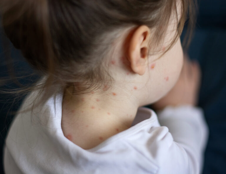 Vaccin till barn mot vattkoppor införs 2027
