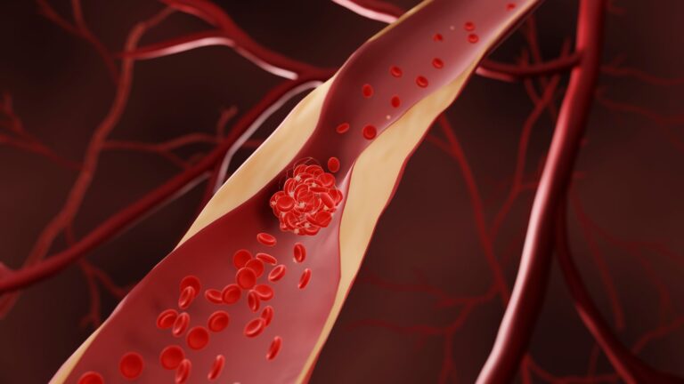 Klopidogrel bättre än ASA efter ballongvidgning