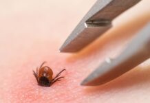 TBE-fallen ökar kraftigt – men var tredje svensk saknar skydd Fästing som sitter på huden. TBE-fallen ökar kraftigt