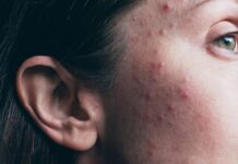 Isotretinoin mot akne under tonåren påverkar inte slutlängden som vuxen Akne kan behandlas med Isotretinoin