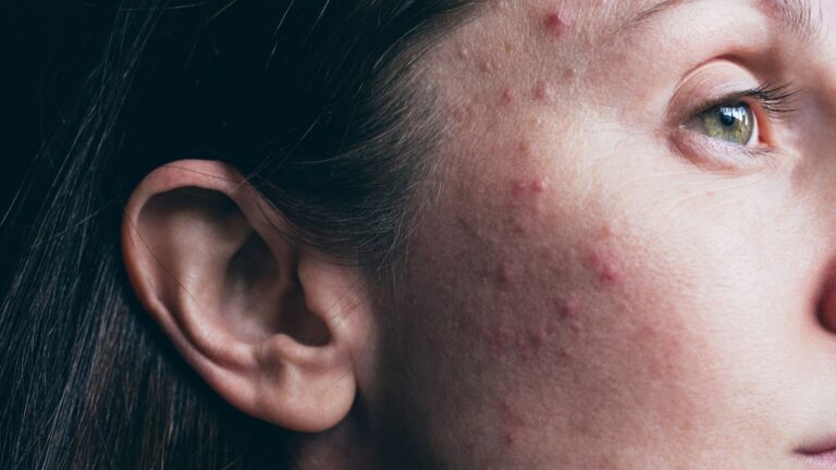 Isotretinoin mot akne under tonåren påverkar inte slutlängden som vuxen