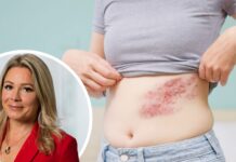 De vill bli först i landet med helt subventionerat bältrosvaccin Bild på person med bältros, och porträtt på Tina Crafoord, som kommenterar förslaget om subventionerat bältrosvaccn i artikeln