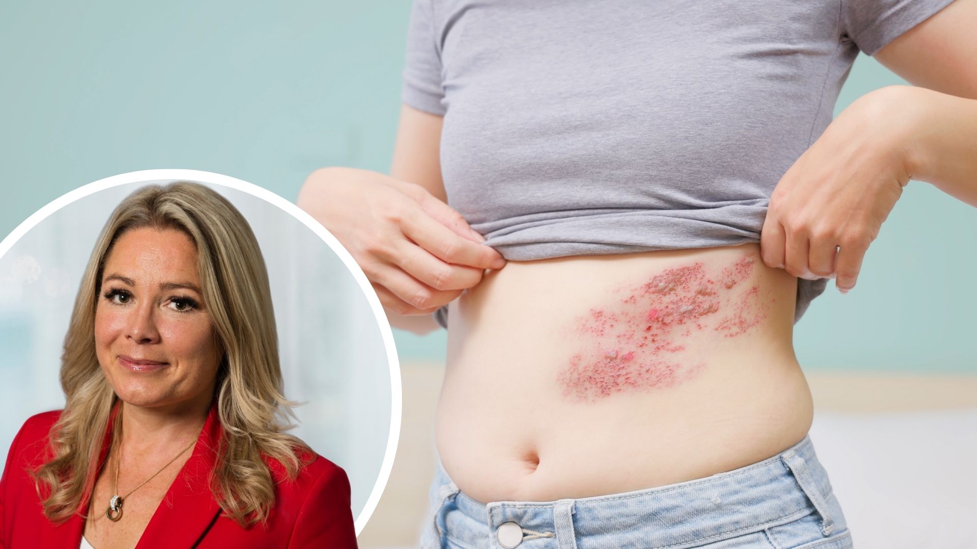 Bild på person med bältros, och porträtt på Tina Crafoord, som kommenterar förslaget om subventionerat bältrosvaccn i artikeln