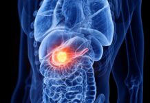 Hoppfulla resultat för en av de dödligaste cancerformerna Bukspottkörtelcancer