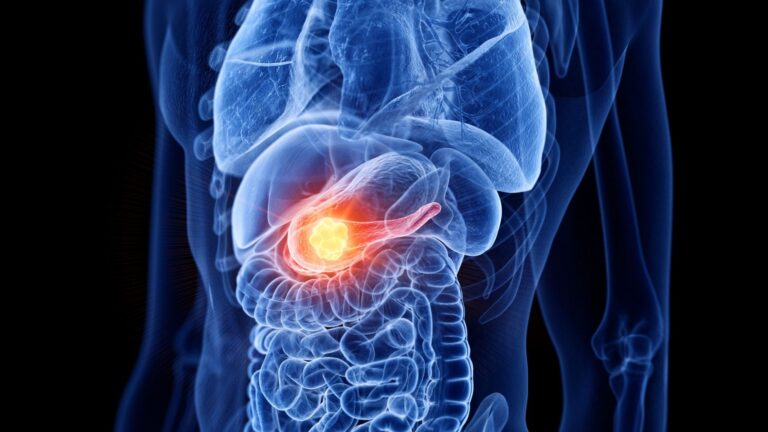 Hoppfulla resultat för en av de dödligaste cancerformerna