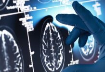 Alzheimerforskningen lämnar amyloidspåret – 158 läkemedel testas Scannade bilder på hjärnor.