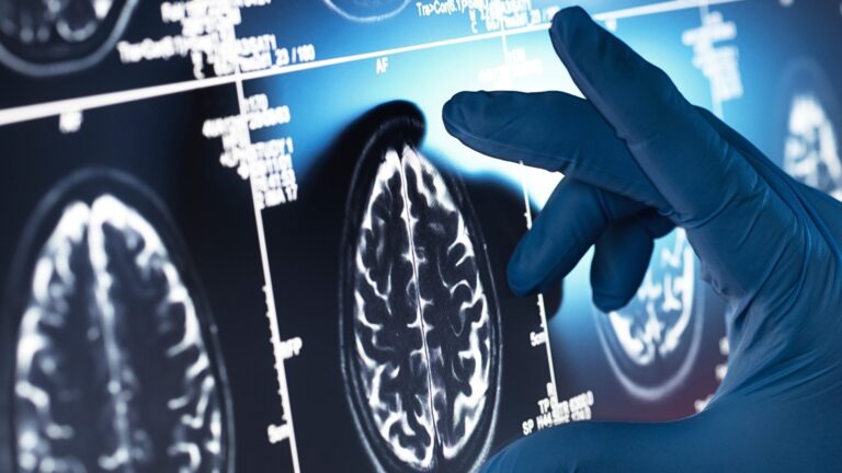 Alzheimerforskningen lämnar amyloidspåret – 158 läkemedel testas