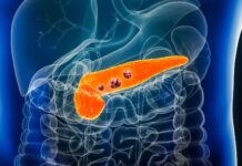 Ny RAS-hämmare godkänd mot spridd bukspottkörtelcancer Illustrerad 3d bild på bukspottkörtelcancer.