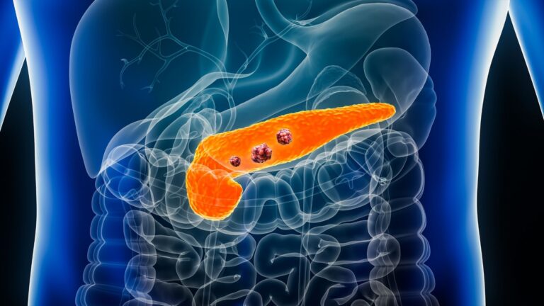 Ny RAS-hämmare godkänd mot spridd bukspottkörtelcancer