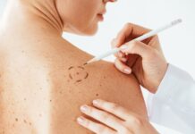 Individanpassat mRNA-vaccin når målen i fas 3-studie mot melanom Undersökning av födelsemärke.