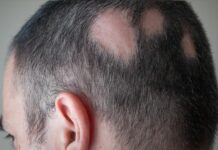 Ny JAK-hämmare visar hög effektivitet vid svårt håravfall Vuxen man med svår alopecia areata.