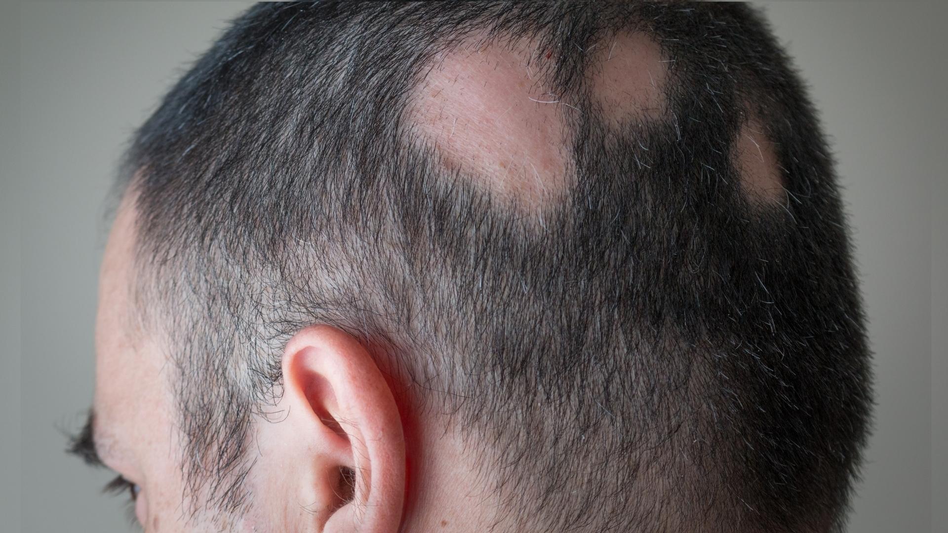 Vuxen man med svår alopecia areata.