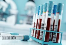 Blodprov upptäckte tidig bukspottkörtelcancer i studie Blodprover i rör