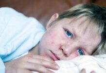 Mässlingsutbrottet är över – vaccinationsskydd begränsade smittan Pojke med mässling