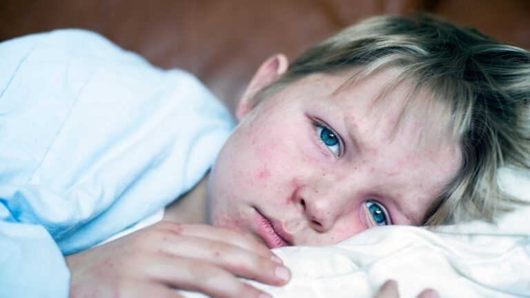 Mässlingsutbrottet är över – vaccinationsskydd begränsade smittan